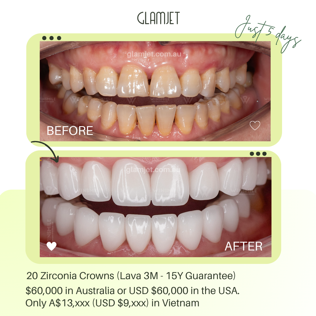 Before and after smile makeover of a Perth woman who regained her confidence after divorce with high-quality dental treatment in Vietnam arranged by Glamjet.com.au. She saved up to 75% compared to Perth prices, enjoyed a great holiday experience, and completed her new smile in just 5 days — much faster than in Australia. Glamjet.com.au is a trusted medical tourism facilitator helping clients from Australia, New Zealand, and the USA achieve beautiful smiles abroad.