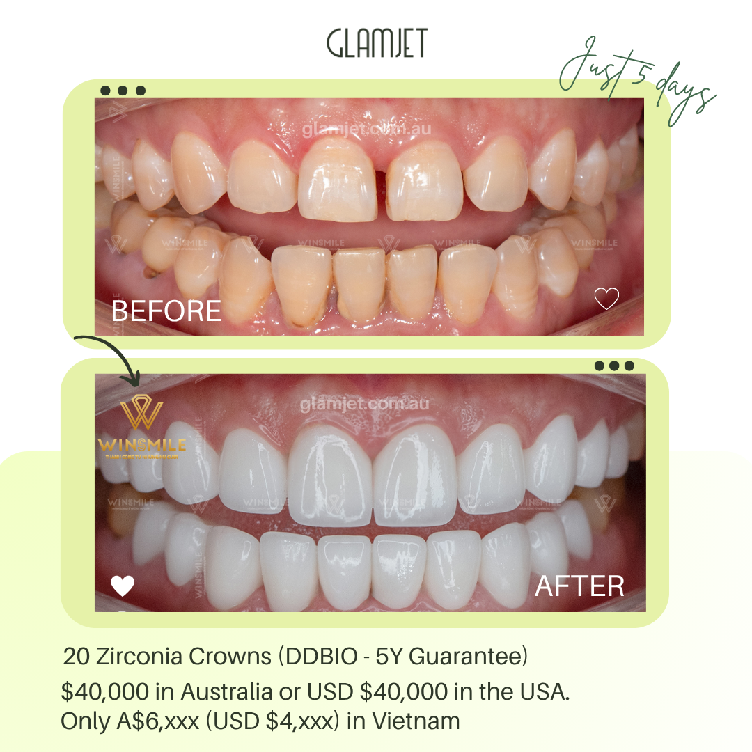 Before and after smile transformation of a client who used to hide her smile because of a front tooth gap. She didn’t want braces, so Glamjet.com.au arranged a zirconia crown treatment in Vietnam to close the gap beautifully. She saved nearly $50,000 compared to Brisbane dental prices and even accessed funding through Australian Super and flexible payment options for international clients.