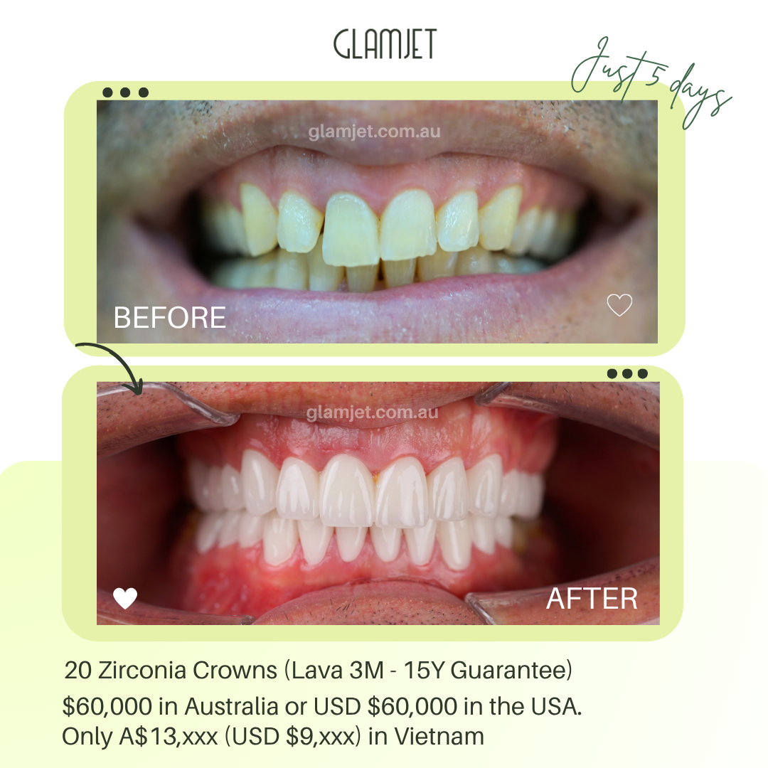 This CEO in Perth, Australia upgraded his professional image with zirconia crowns via Glamjet.com.au. Top dentists in Hanoi and Ho Chi Minh Vietnam, great prices save more than booking direct. Finish in 3–5 days