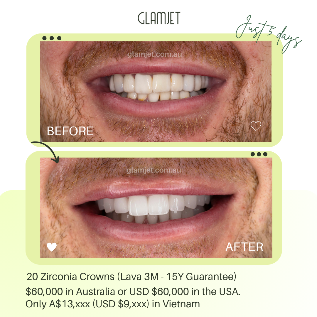 Melbourne executive’s smile makeover with Lava 3M zirconia crowns in Hanoi via Glamjet.com.au saved $40,000 vs local dental costs and paid with Super. He now has beautiful Hollywood smile