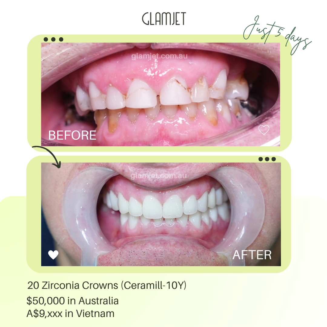Before and after Brisbane CEO’s bruxism restoration premium implants and zirconia crowns arranged by Glamjet.com.au dental tourism experts.