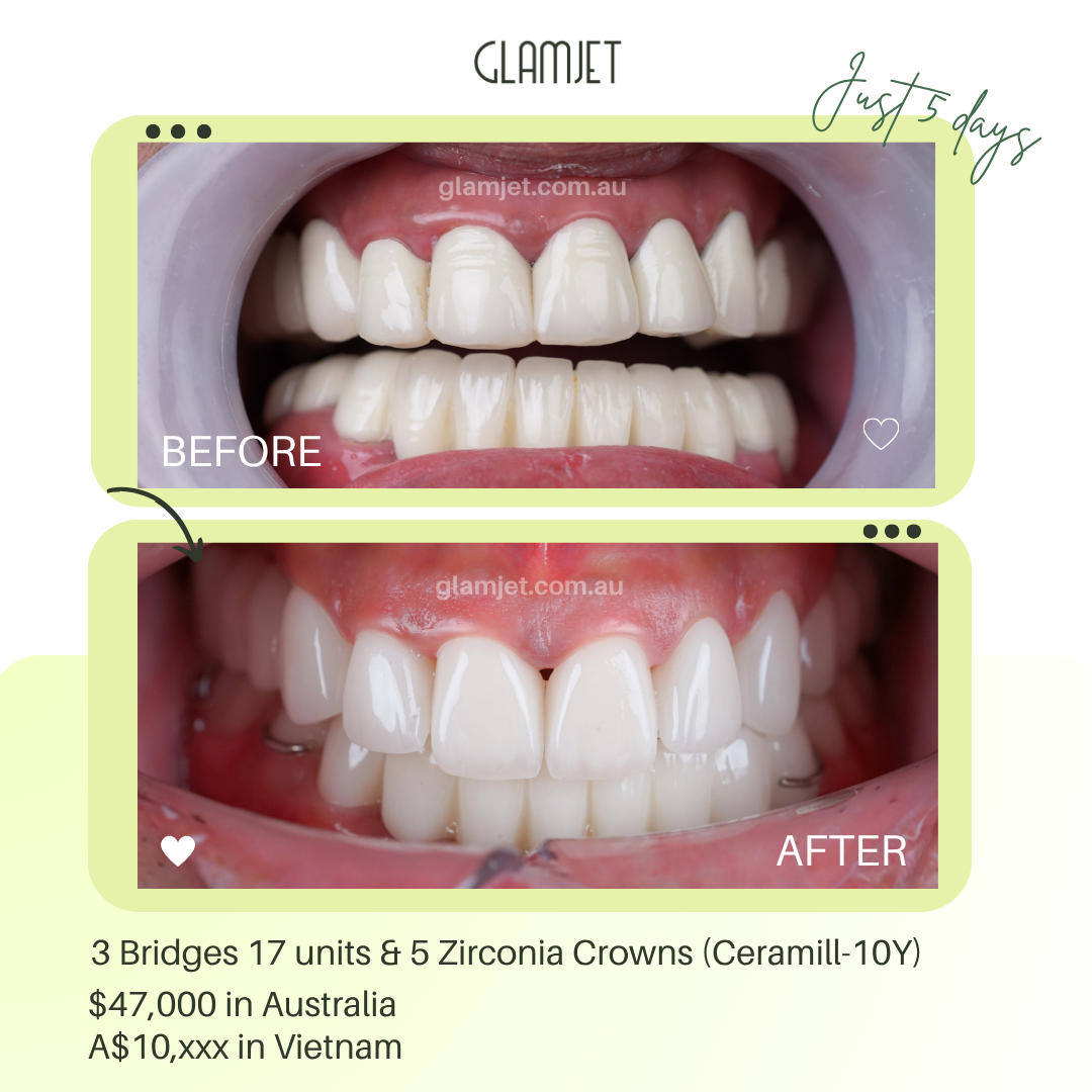 Philippine male nurse’s smile makeover with zirconia crowns and bridges in Vietnam via Glamjet.com.au affordable, natural, and confidence-boosting. You can see before and after images here