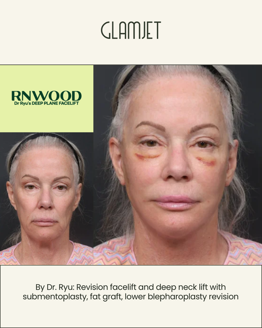 The Endotine Forehead Lift: How It Works, What It Costs, and What to Expect