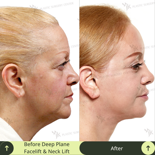 What Is a Deep Plane Facelift and How Does It Work?