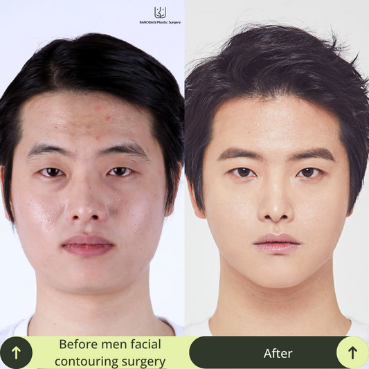 Your Complete Guide to Recovery After Facial Contouring Surgery In South Korea