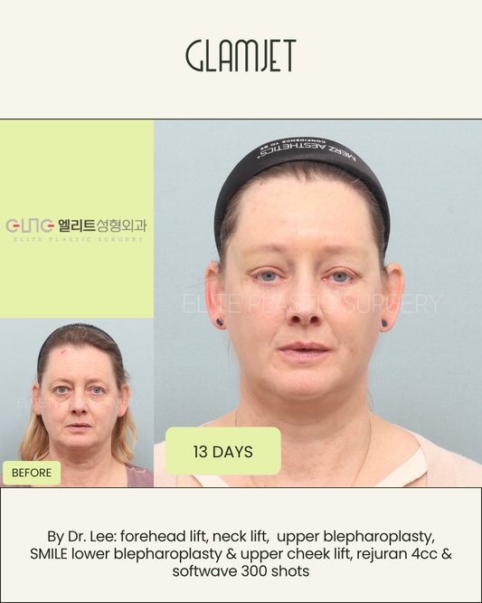 Facelift Types Explained: Which One Is Right for You?