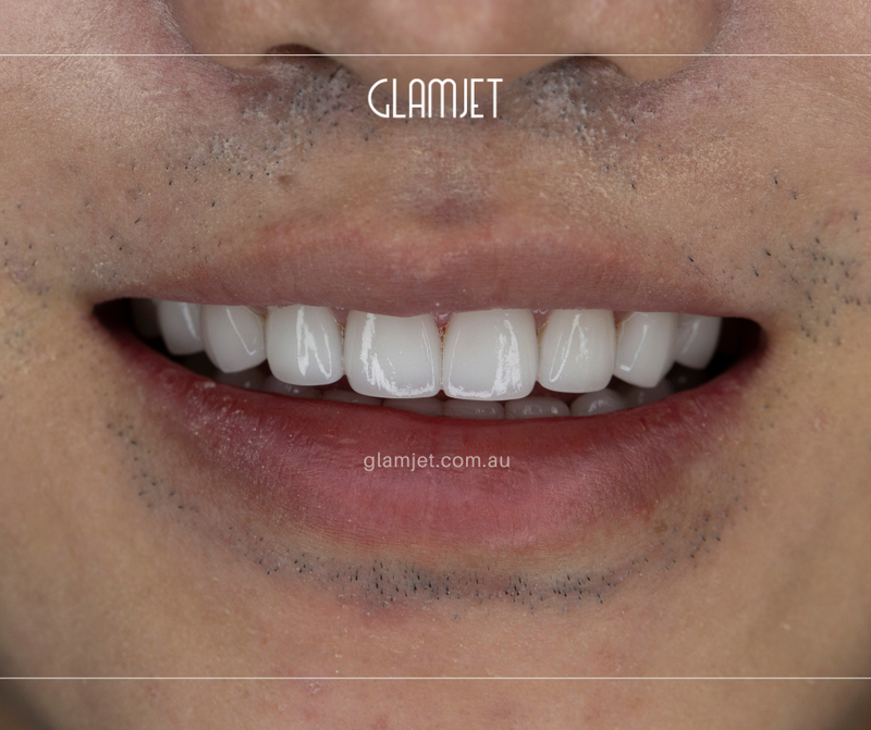 After - Case 2: 8 minimal prep Emax veneers for top jaw