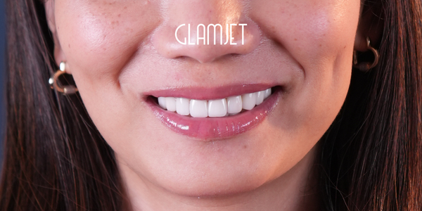 LiSi/Lumineers Veneer