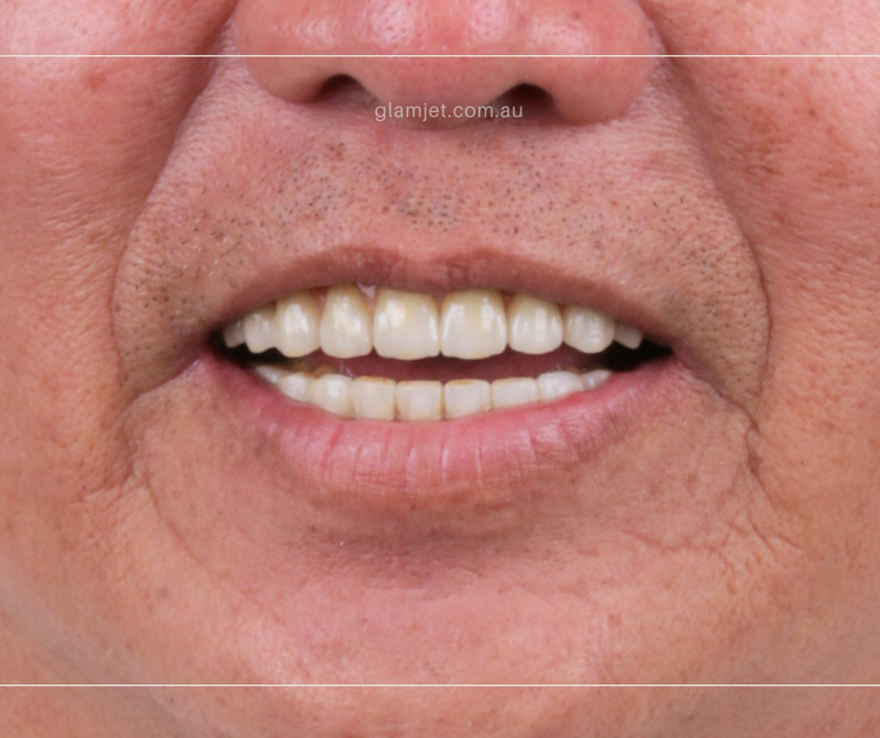 After - Case 5 - American client before and after all-on-4 implants in Vietnam (top and bottom jaws)