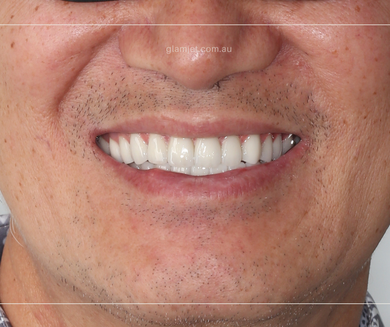 After - Case 6 - American client before and after all-on-6 implants in Vietnam (top and bottom jaws)