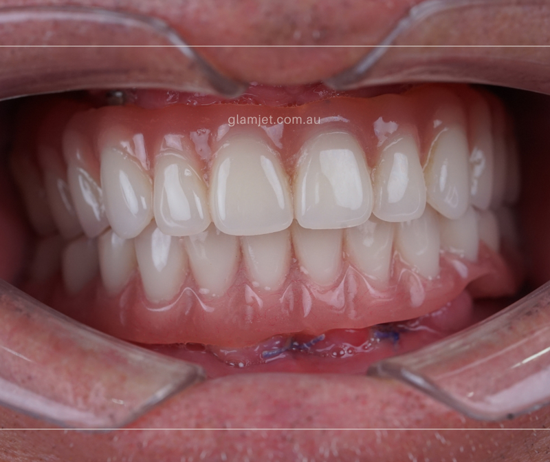 After - Case 1 - Replace failed all-on-4 implants in Australia with all-on-6 dental implants in Vietnam