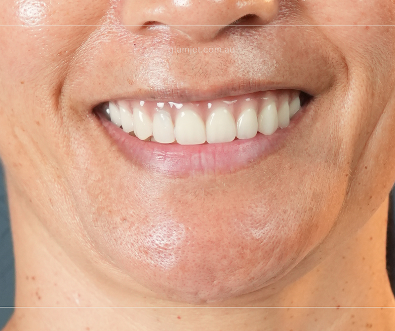 After - Case 2 - New Zealand client before and after all-on-6 dental implants in Hanoi (top and bottom)