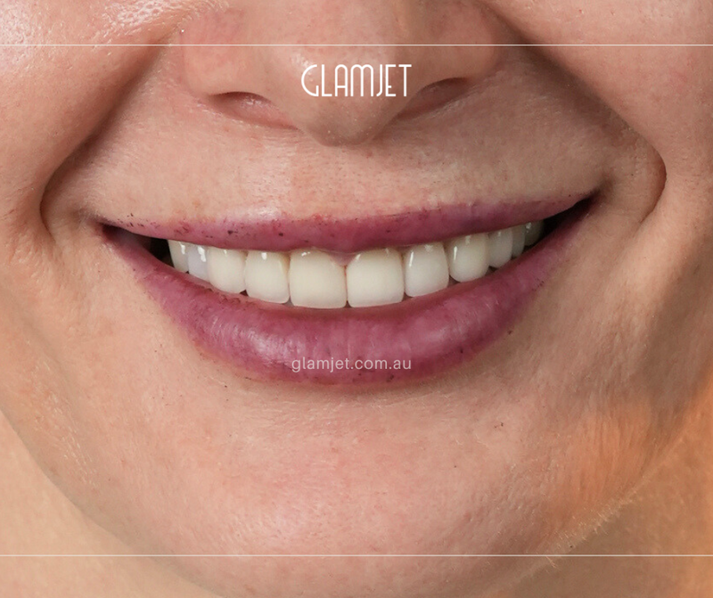 After - Case 3: 9 Emax veneers and 1 zirconia crown