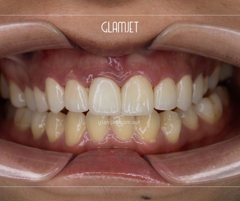After - Case 4: 9 Emax veneers and 1 zirconia crown