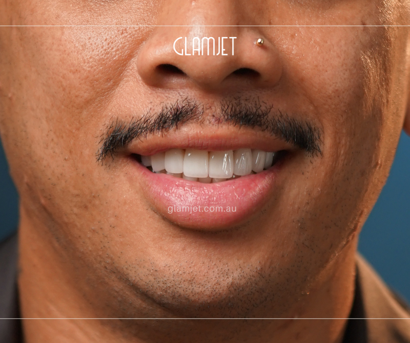 After - Case 5: 16 Emax veneers and 4 zirconia crowns