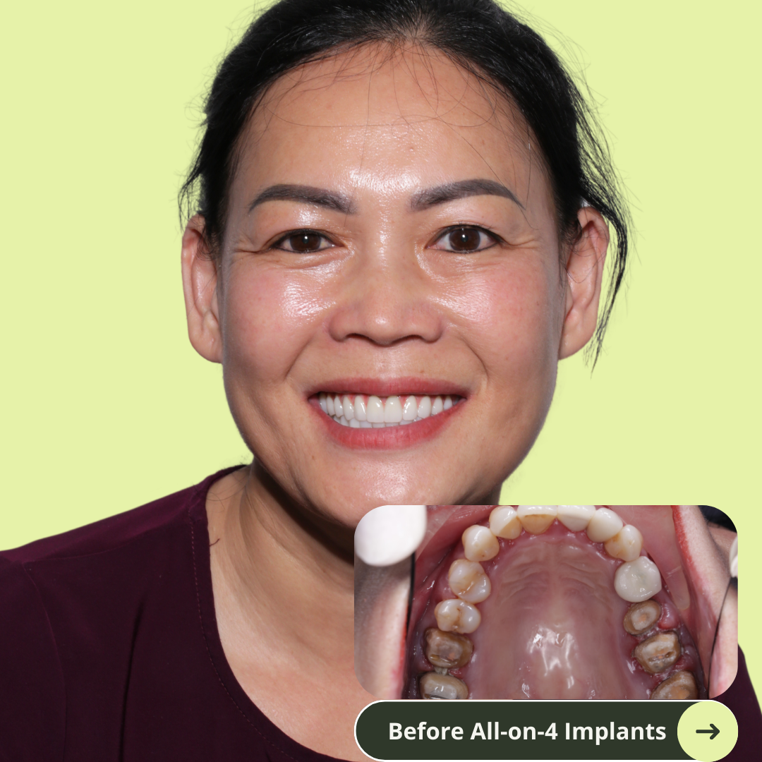 Photo of an Australian women smile after all-on-4 dental implants with porcelain bridge in Vietnam. It costs ten of thousands less than prices in Australia, the US, New Zealand. It's even cheaper than Thailand. She has beautiful white and translucent teeth after dental implants. No more missing teeth. 