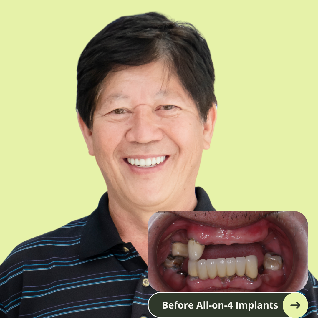 Photo of an American women smile after all-on-4 dental implants with porcelain bridge in Vietnam. It costs ten of thousands less than prices in Australia, the United States, New Zealand. It's even cheaper than Thailand. He has beautiful white and translucent teeth after dental implants. No more missing teeth. 