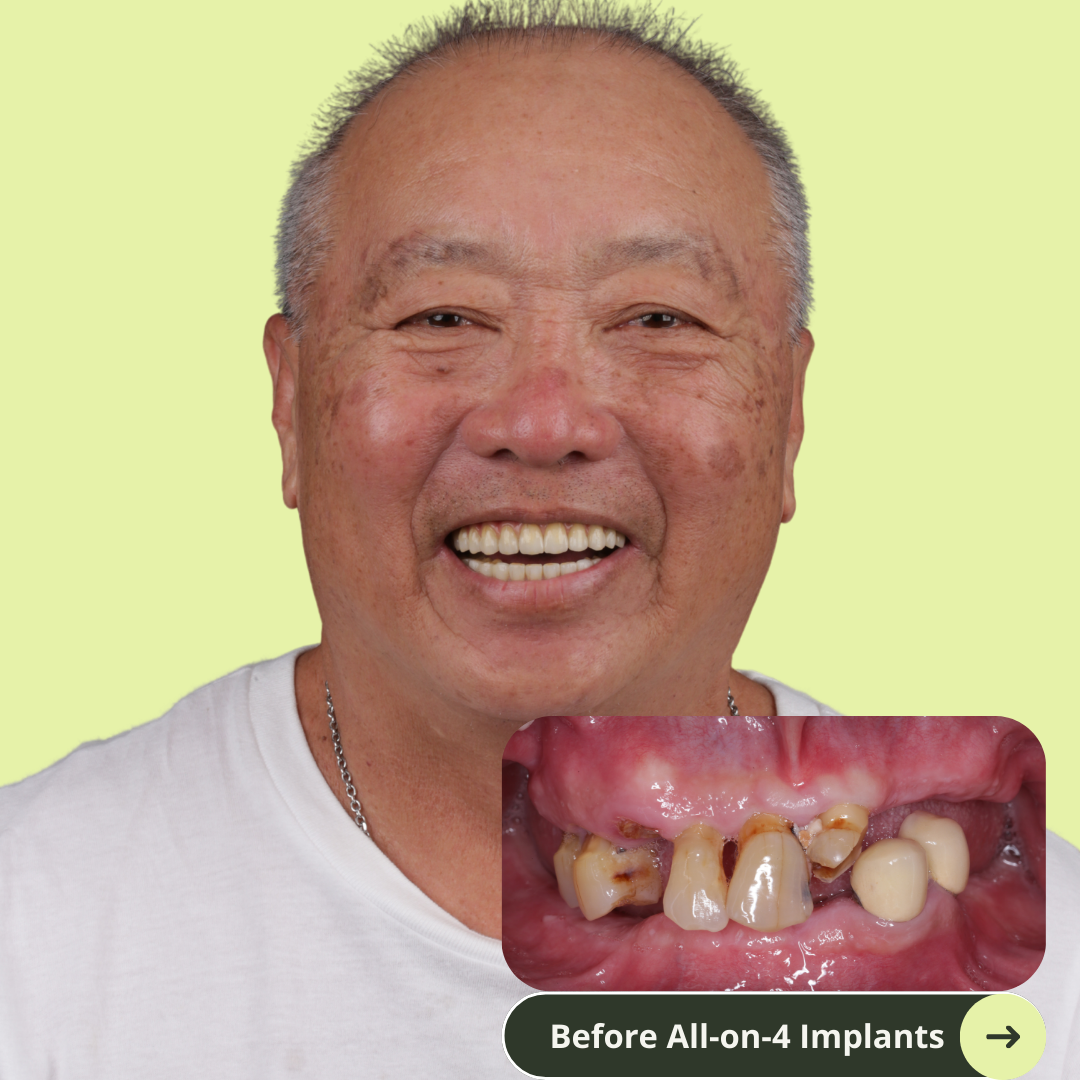 Photo of an American men smile after all-on-4 dental implants with porcelain bridge in Vietnam. It costs ten of thousands less than prices in Australia, the US, New Zealand. It's even cheaper than Thailand. He has beautiful white and translucent teeth after dental implants. No more missing teeth. 