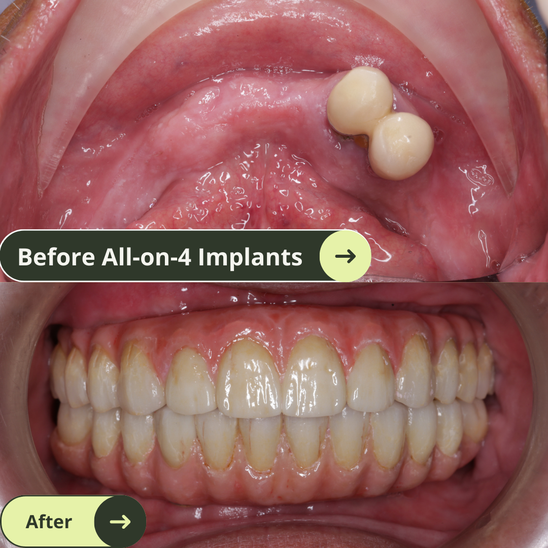 Before and after photo of an Australian men teeth after all-on-4 dental implants with porcelain bridge in Vietnam. It costs ten of thousands less than prices in Australia, the US, New Zealand. It's even cheaper than Thailand. He has beautiful white and translucent teeth after dental implants. No more missing teeth. 