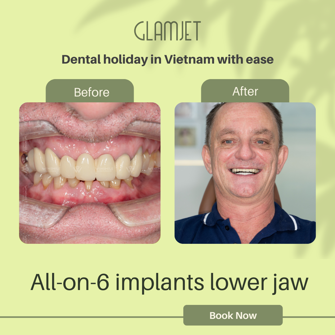 Before and after photos of a dental restoration treatment for an Australian with teeth loss, weak teeth, and gum disease. He has affordable all-on-4 and all-on-6 dental implants with porcelain crowns in a top rated dental clinic in Ho Chi Minh city, Vietnam with dentists with years of experience with Glamjet. Glamjet made dental holidays in Vietnam, Thailand, and Bali easy for many people in Australia, New Zealand, and the USA with all-inclusive packages and payment plans. 