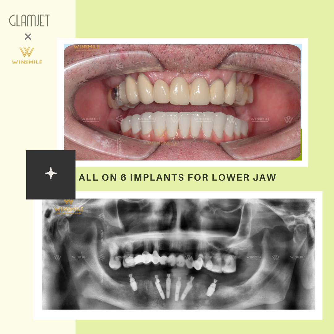 Before and after photos of a dental restoration treatment for an Australian with teeth loss, weak teeth, and gum disease. He has affordable all-on-4 and all-on-6 dental implants with porcelain crowns in a top rated dental clinic in Ho Chi Minh city, Vietnam with dentists with years of experience with Glamjet. Glamjet made dental holidays in Vietnam, Thailand, and Bali easy for many people in Australia, New Zealand, and the USA with all-inclusive packages and payment plans. 