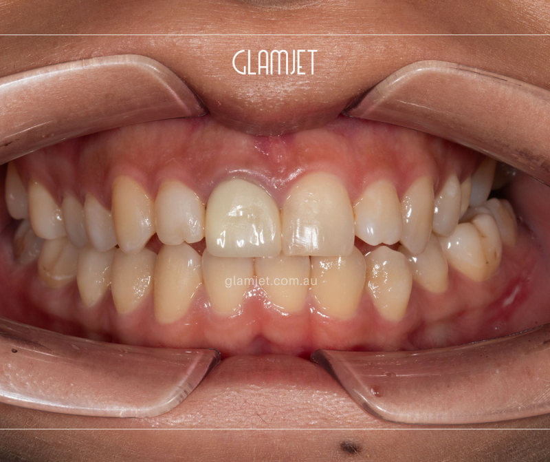 Before - Case 4: 9 Emax veneers and 1 zirconia crown