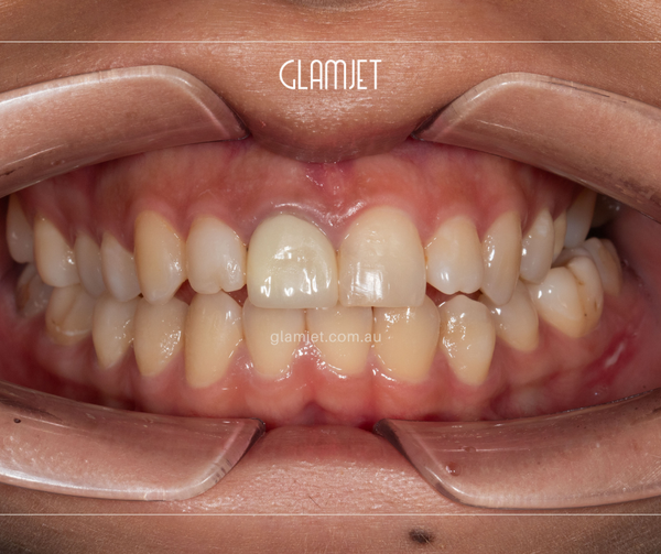 E-max Veneer