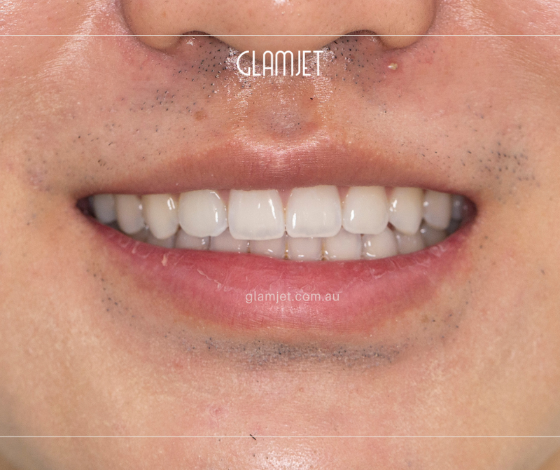 Before - Case 2: 8 minimal prep Emax veneers for top jaw