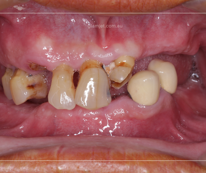 Before - Case 5 - American client before and after all-on-4 implants in Vietnam (top and bottom jaws)