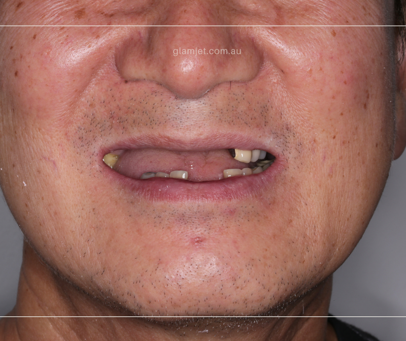 Before - Case 6 - American client before and after all-on-6 implants in Vietnam (top and bottom jaws)