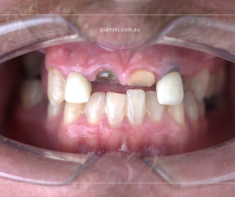 Before - Case 4 - Australian patient before and after all-on-6 implants for top jaw in Vietnam