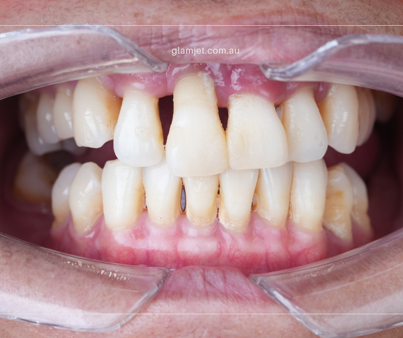 Before - Case 2 - New Zealand client before and after all-on-6 dental implants in Hanoi (top and bottom)