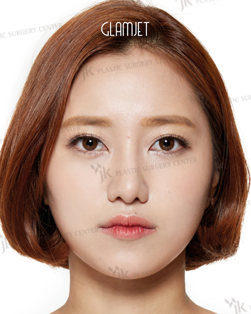 After - Dr. Kim: Bulbous nose rhinoplasty with bridge augmentation, osteotomy, alar base reduction, tip plasty