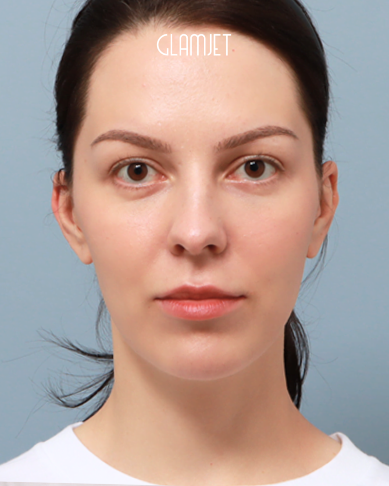 Before - Dr. Jin: Rhinoplasty with hump removal, deviated nose correction, and tip correction