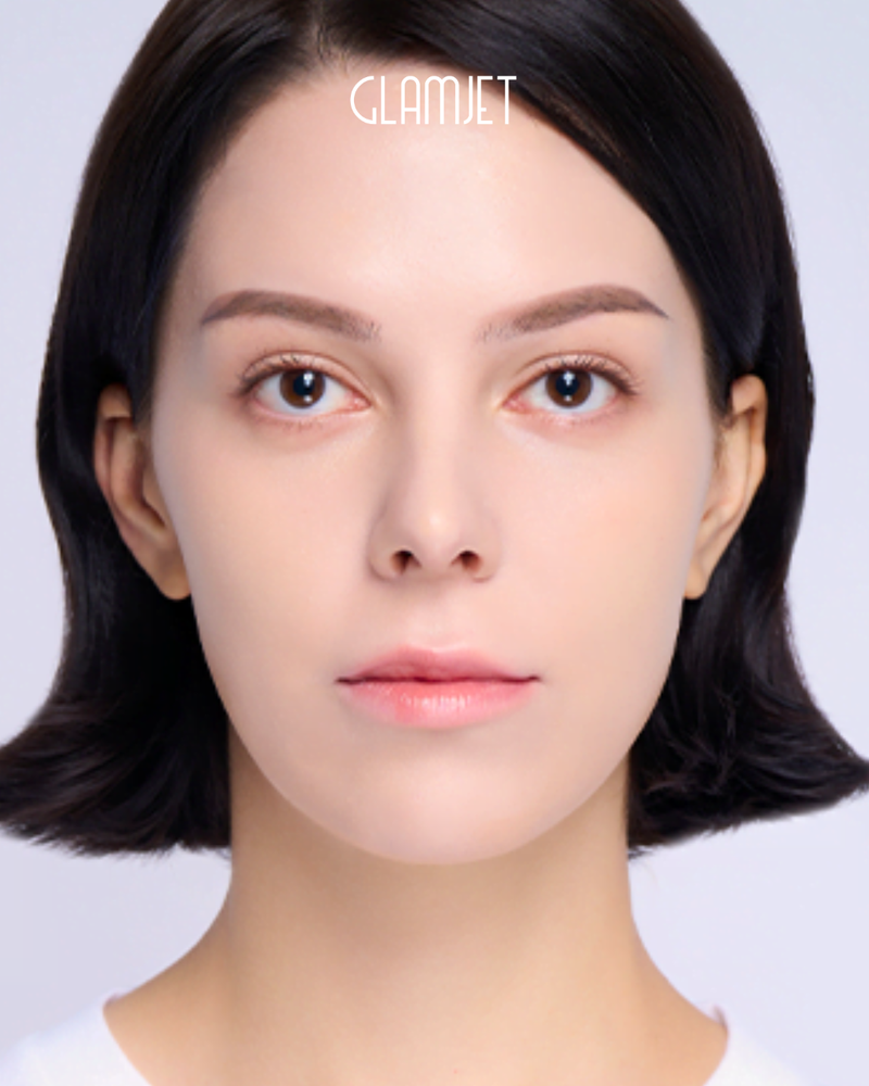 After - Dr. Jin: Rhinoplasty with hump removal, deviated nose correction, and tip correction
