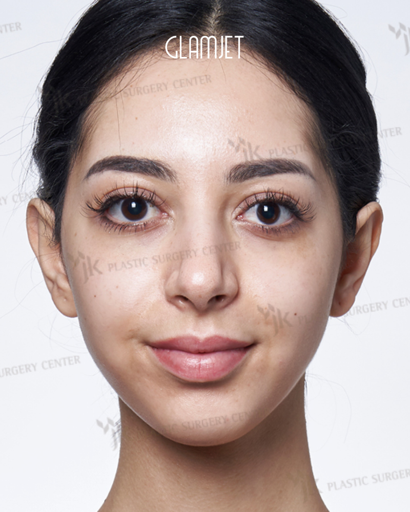 Before - Dr Kim: Rhinoplasty with hump removal, tip plasty and hanging columella correction