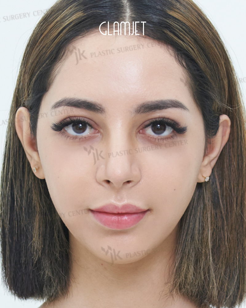 After - Dr Kim: Rhinoplasty with hump removal, tip plasty and hanging columella correction