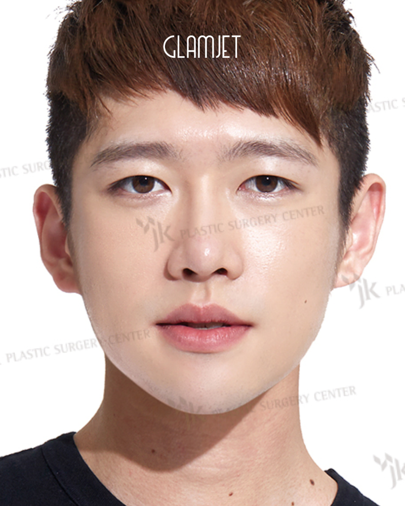 After - Dr Kim: rhinoplasty with alar base reduction, tip plasty, hanging columella correction, nasal osteotomy