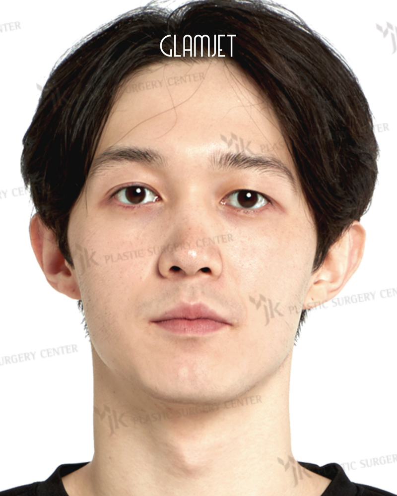 Before - Dr Kim: rhinoplasty with hump removal, tip plasty, osteotomy, hanging collumella correction, alar cartilage graft
