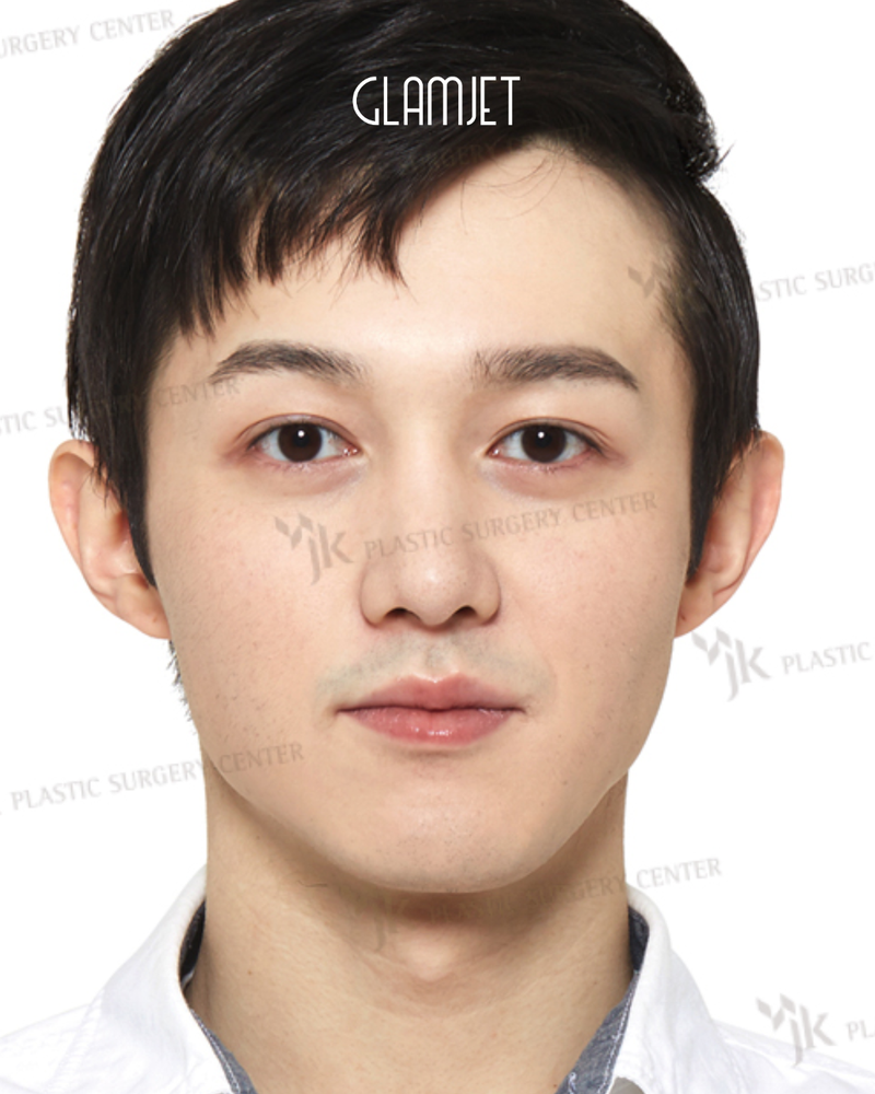 After - Dr Kim: rhinoplasty with hump removal, tip plasty, osteotomy, hanging collumella correction, alar cartilage graft