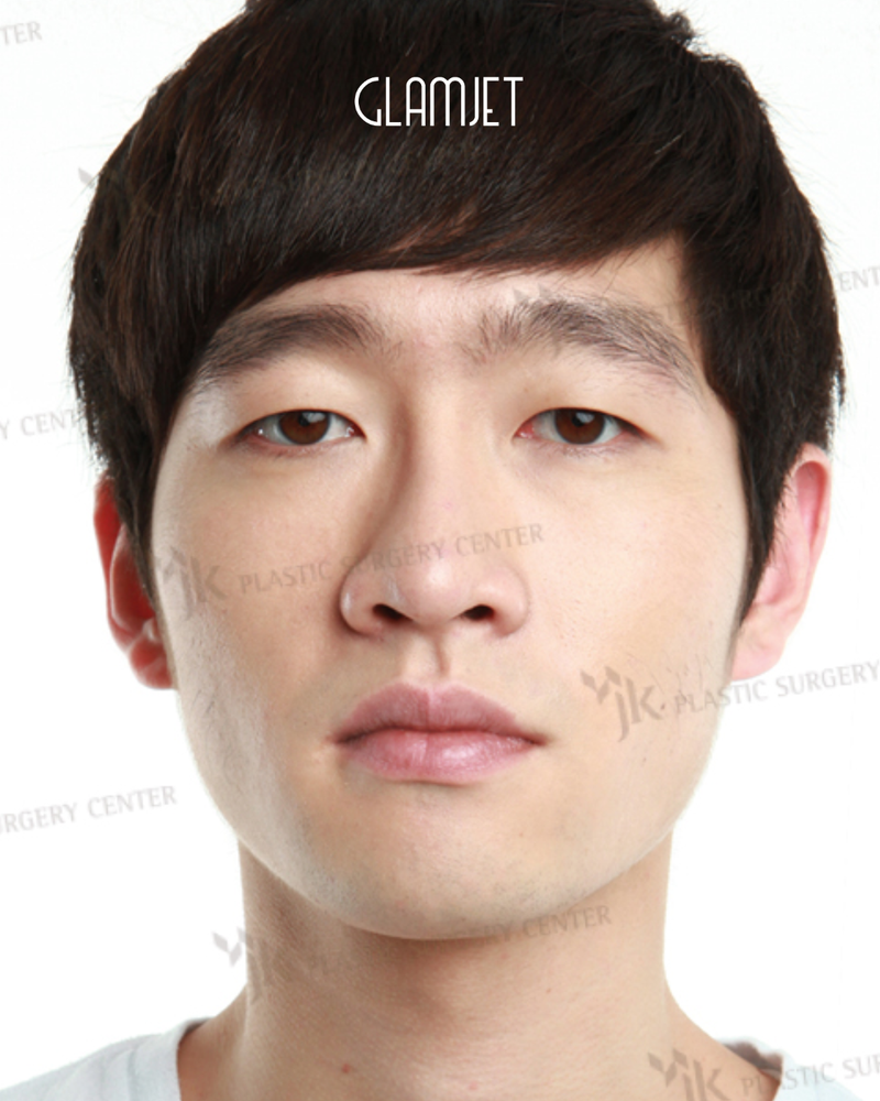 Before - Dr Kim: rhinoplasty with alar base reduction, tip plasty, hanging columella correction, nasal osteotomy