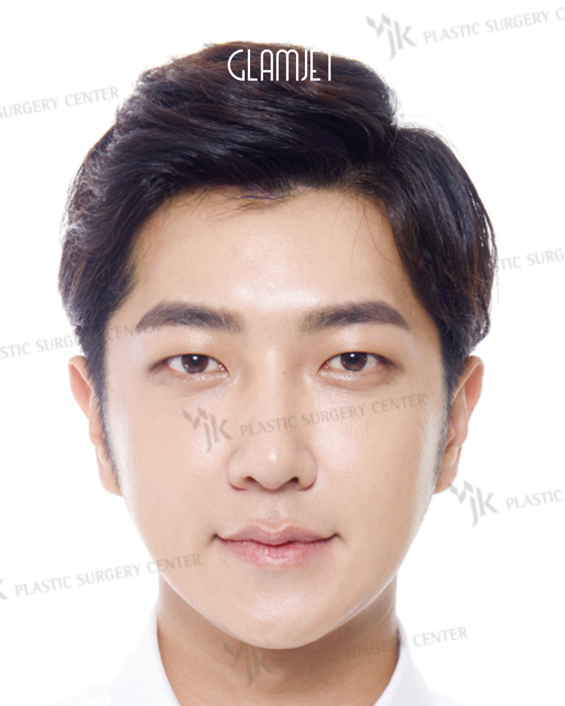 After - Dr Kim: Revision rhinoplasty with rib cartilage, tip correction, alar base reduction