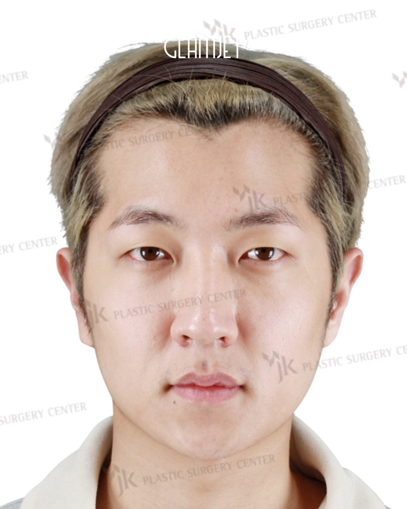 Before - Dr Kim: Revision rhinoplasty with rib cartilage, tip correction, alar base reduction