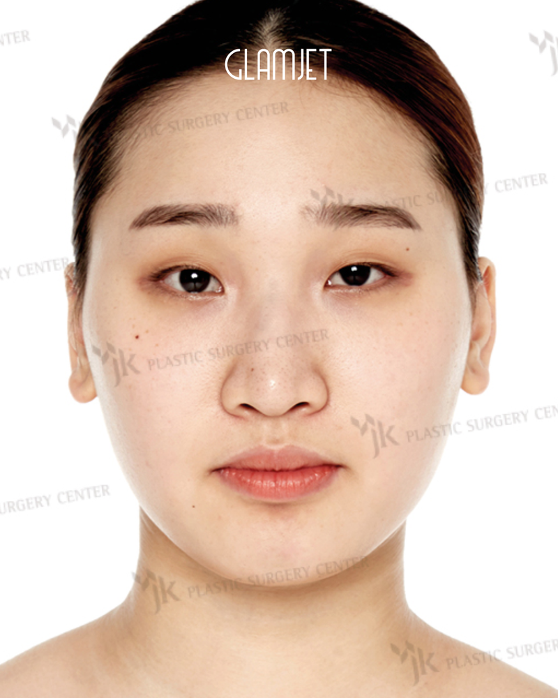 Before - Dr Kim: Bulbous nose rhinoplasty with bridge augmentation, osteotomy, alar base reduction, tip plasty
