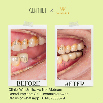 An image showcasing the before and after results of dental implant treatment for teeth loss at a leading dental clinic Win Smile Dental with branches in Ha Noi and Ho Chi Minh City, Vietnam. Glamjet has assisted numerous Australians, New Zealanders, and Americans in planning dental tourism holidays in Vietnam, Thailand, Bali, offering affordable porcelain crowns, no prep veneers, Emax ceramic veneers, dental implants, all-on-4 and all-on-6 implants, dentures, zygomatic implant, root canal, teeth whitening 