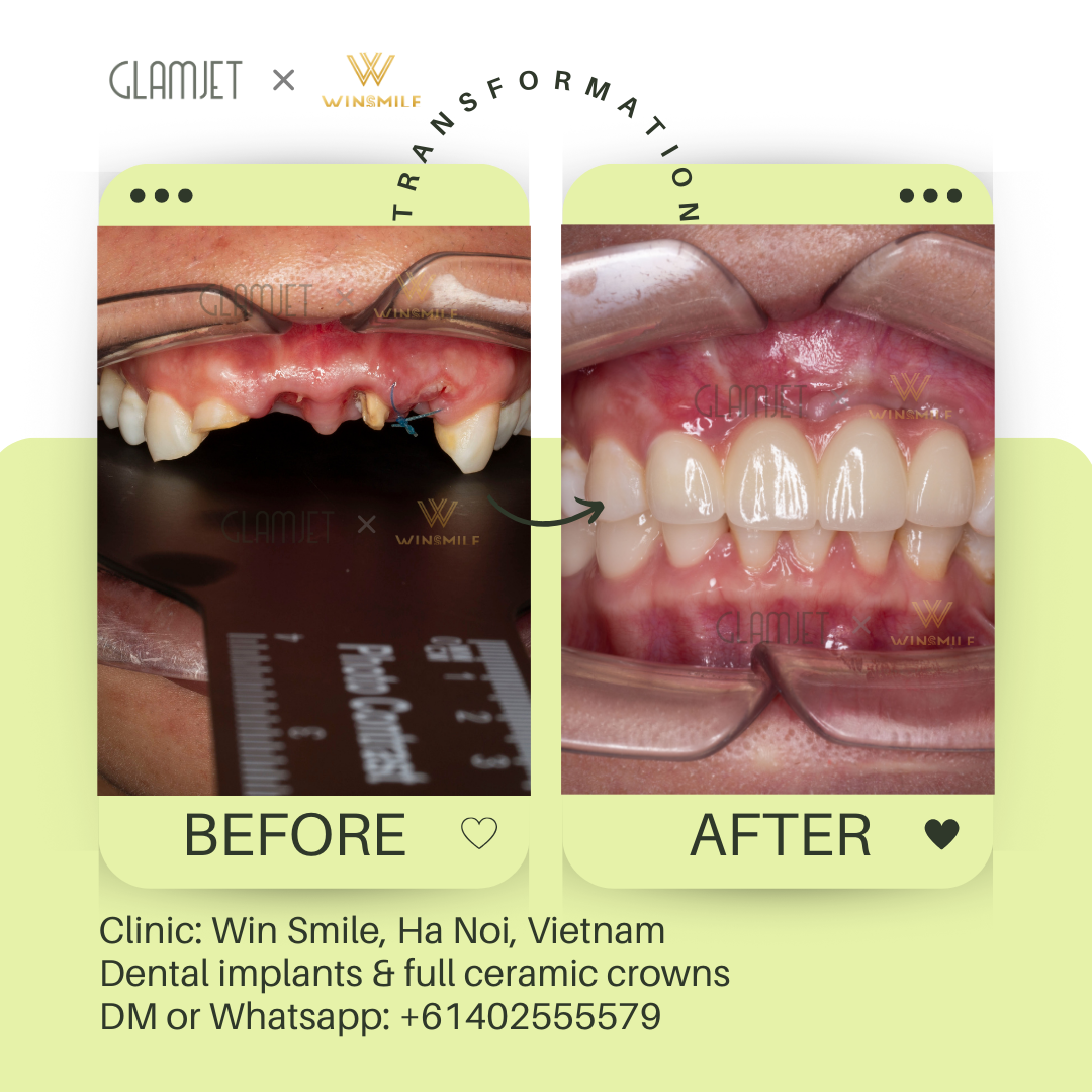 Before and after photos of dental implants for teeth loss of front tooth, highlighting the expertise of Vietnam’s best dentists at a top dental clinic in Hanoi and Ho Chi Minh city, Vietnam. Glamjet has supported clients from Australia, New Zealand, and America in arranging cost-saving dental tourism holidays in Vietnam, Thailand, Bali, featuring porcelain crowns, Emax ceramic veneers, no prep veneers, dental implants, all-on-4 implants, dentures, teeth whitening, zygomatic implants, root canal 