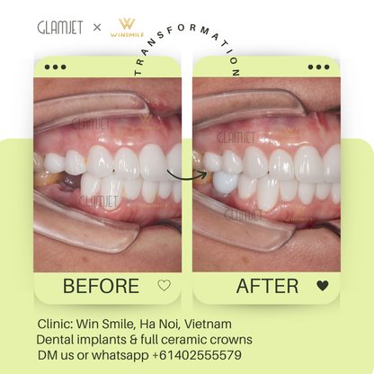 Before and after images of dental implants for teeth loss, showcasing affordable treatment at top dental clinic, Win Smile, with branches in Hanoi and Ho Chi Minh city in Vietnam. Glamjet arranges dental tourism holidays for many Australians, New Zealand, Canadian, Americans to Vietnam, Bali, and Thailand, offering services like porcelain crowns, Emax veneers, no prep veneers, porcelain veneers, all-on-4 and all-on-6 implants, teeth whitening, zygomatic implants, and dentures. Payment plans included 