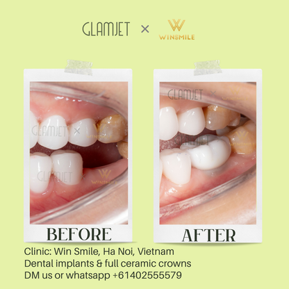 Before and after images of zygomatic implants performed at a top rated dental clinic in Hanoi, Vietnam. Glamjet offers seamless dental tourism planning to Vietnam, Bali, and Thailand, connecting Australian, New Zealand, American, Canadian clients with affordable treatments like porcelain crowns, no-prep veneers, Emax veneers, dental implants, all-on-4 and all-on-6 implants and dentures, root canal treatment, teeth whitening. Payment plans available. 