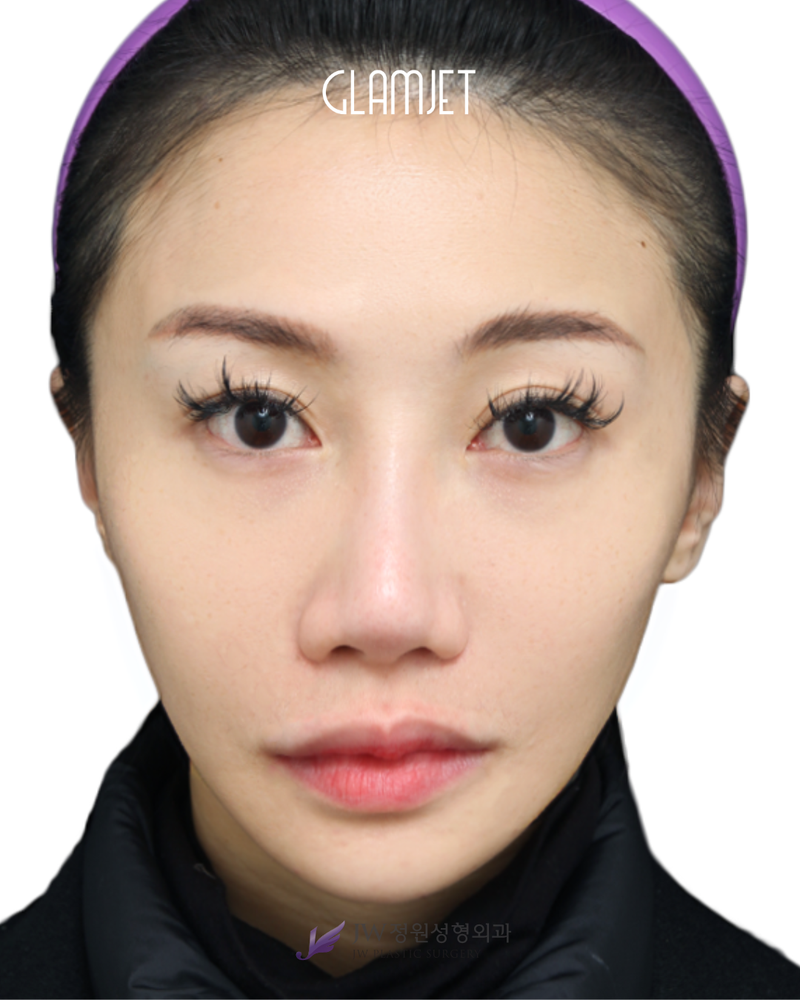 Before - Dr. Man: Revision rhinoplasty 