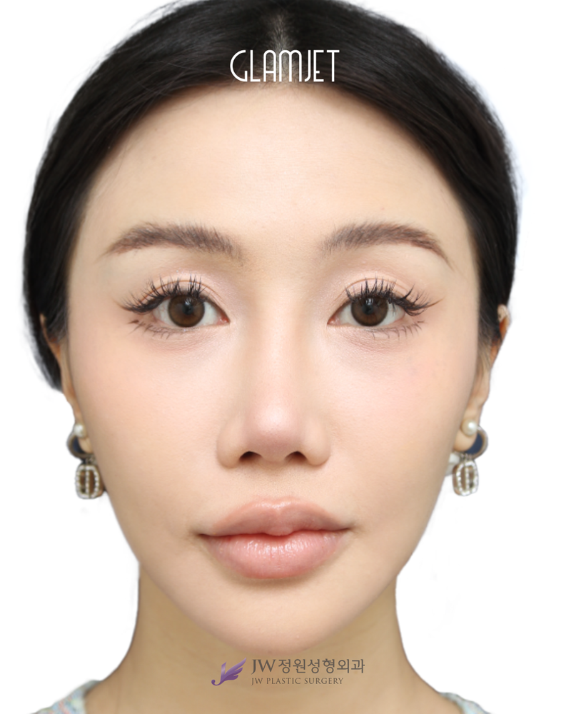 After - Dr. Man: Revision rhinoplasty 